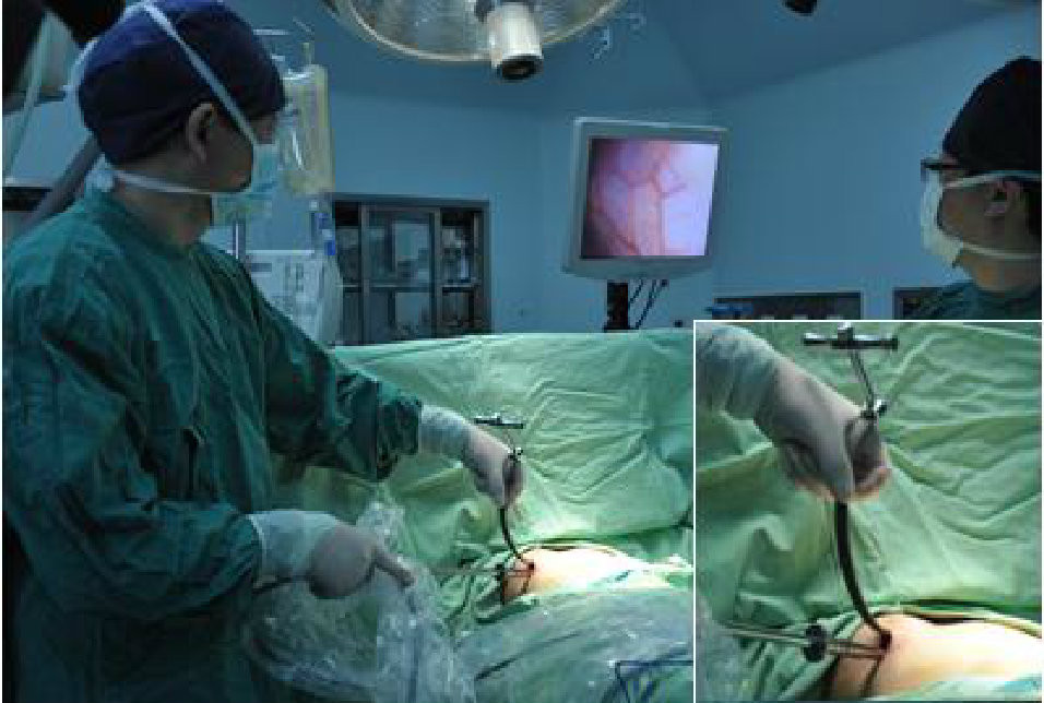 第五步：插入腔镜与钛板。
