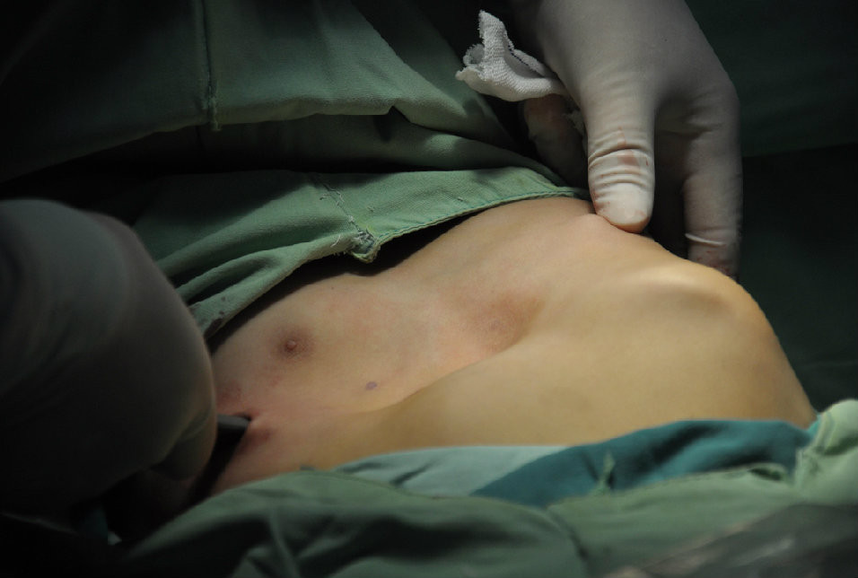 第六步：从对侧穿出肋间。