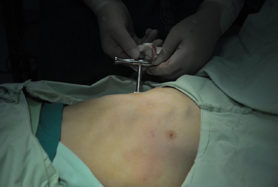 第七步：翻转钛板顶起凹陷