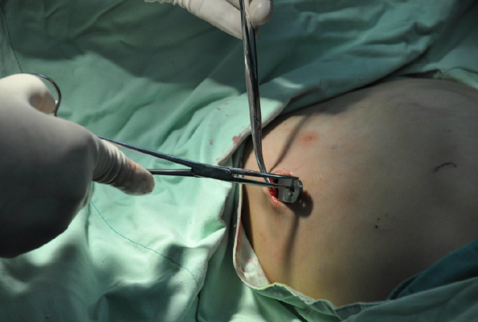 第八步：放入垫片，手术完成。