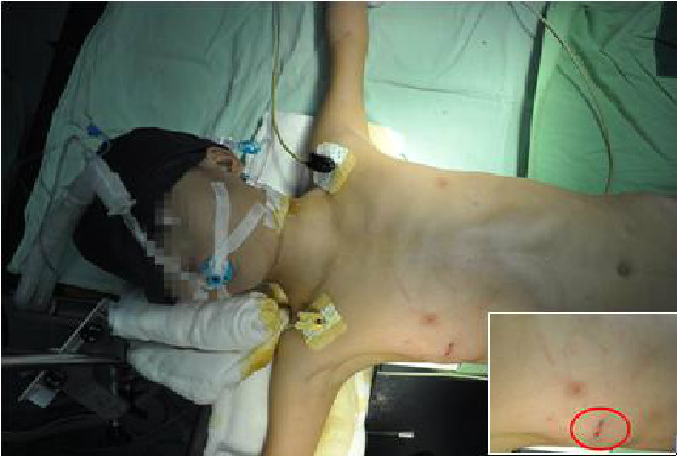 整个手术大约十分钟左右完成，患者全身只有一个1-2cm的小孔。